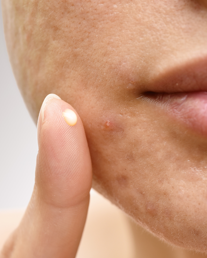 Retinol for acne scars