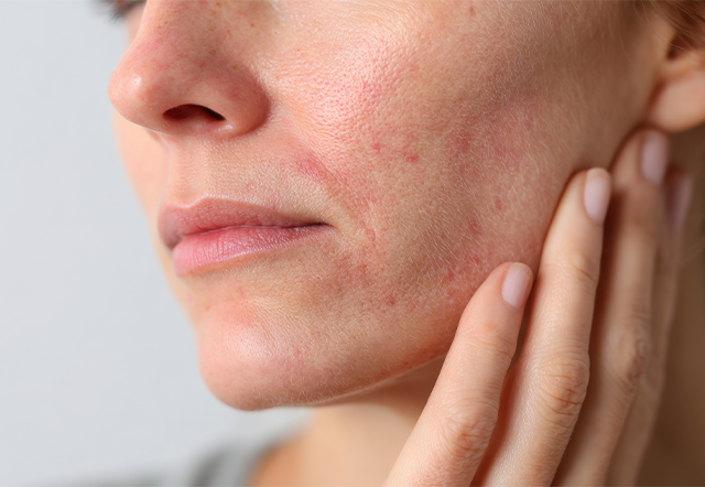 Blemished skin during menopause